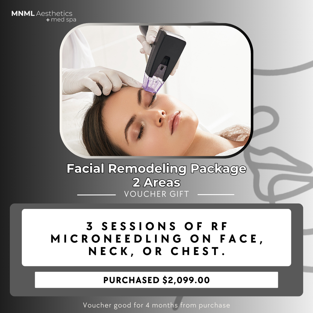 Facial Remodeling Package - 2 Areas